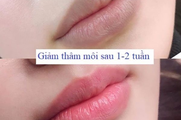 Sau Khi Khử Thâm Tại Ngọc Viện