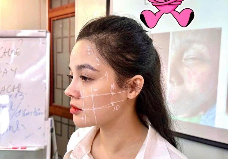Tiêm 24 điểm giúp phục hồi trắng sáng