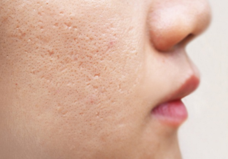Xử lý sẹo rỗ uy tín bình chánh