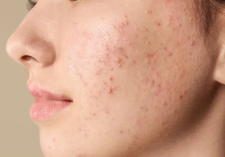 Xử lý mụn uy tín hiệu quả bình Chánh