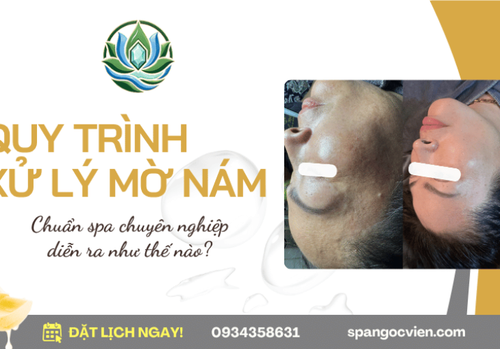 Quy trình xử lý mờ nám chuẩn spa chuyên nghiệp diễn ra như thế nào?