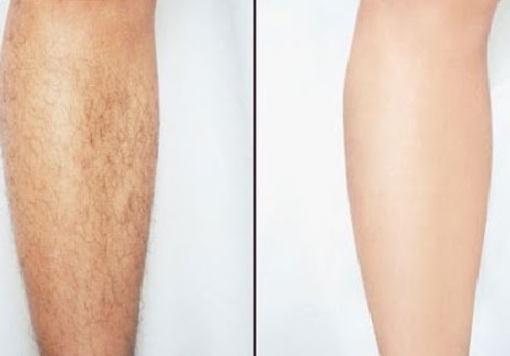 Triệt Lông Vĩnh Viễn