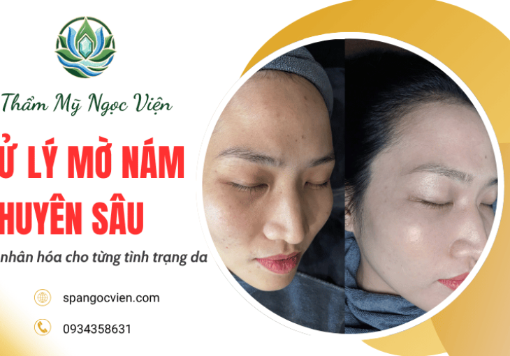 Xử lý mờ nám chuyên sâu - Giải pháp cá nhân hóa cho từng tình trạng da