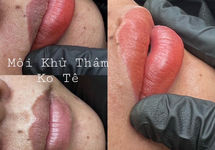 Môi Khử Thâm