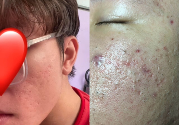 Spa Điều Trị Mụn Uy Tín Tại Bình Chánh