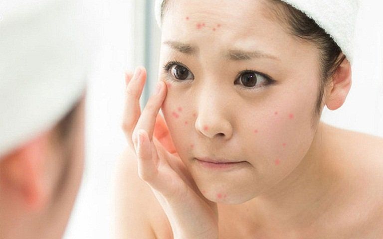 Để trị mụn bạn cần chăm sóc phần da bị mụn mỗi ngày