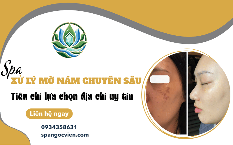 spa xử lý mờ nám