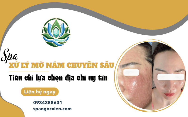 spa xử lý mờ nám
