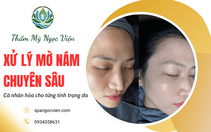 xử lý mờ nám