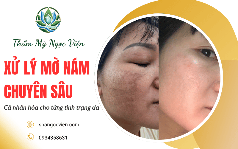 xử lý mờ nám