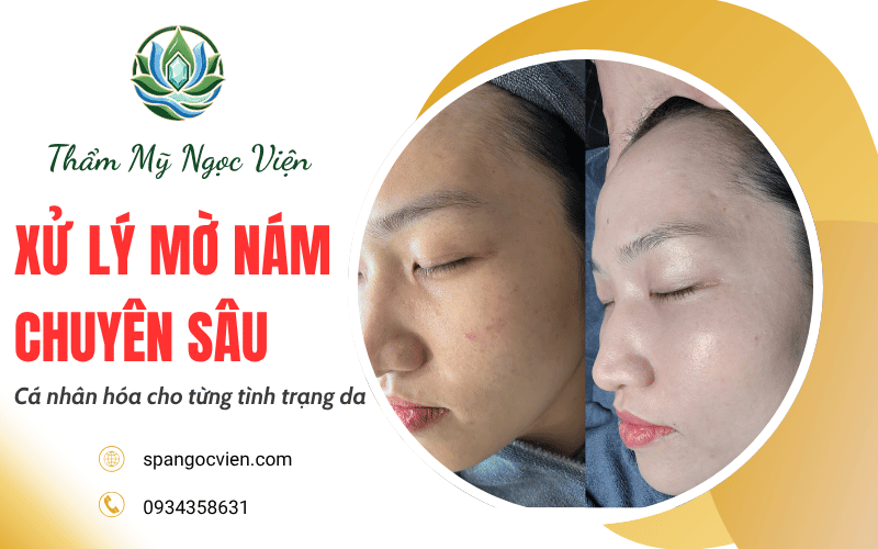 xử lý mờ nám