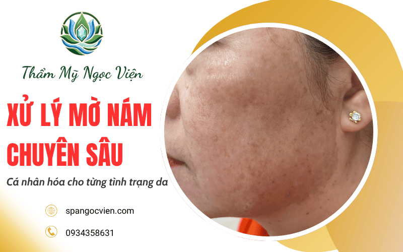 xử lý mờ nám