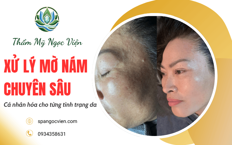 xử lý mờ nám