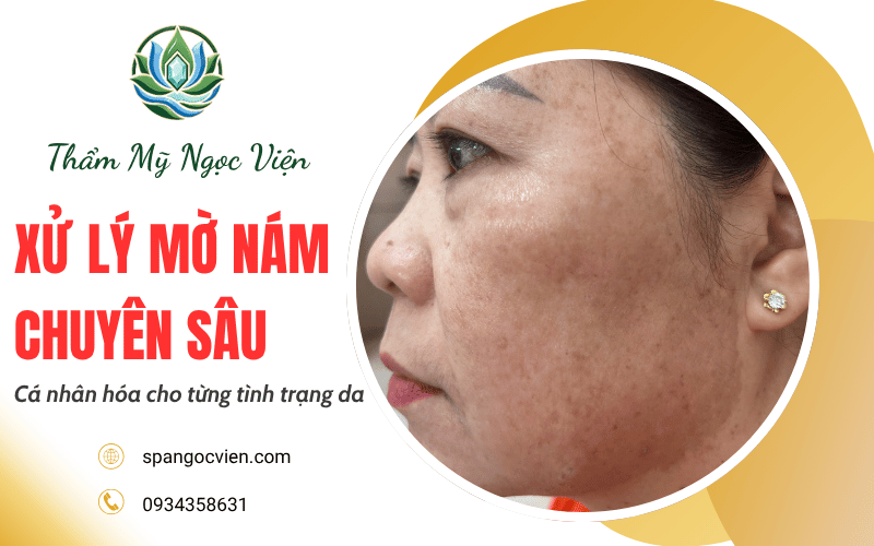 xử lý mờ nám