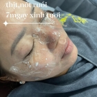Đốt Tàn Nhan, Mụn Thịt, Nốt Ruồi